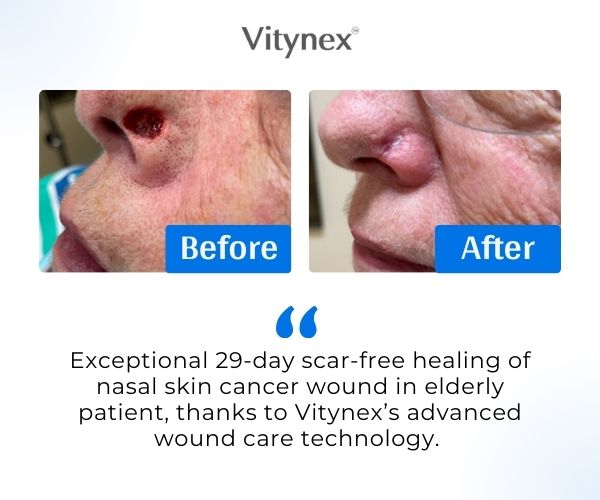 Vitynex Calendula Wound Care Cream | Bed Sore & Diabetic Ulcer | 4X Fast Healing | Safe & Natural