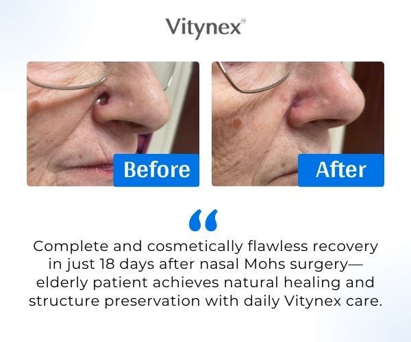 Vitynex Calendula Wound Care Cream | Bed Sore & Diabetic Ulcer | 4X Fast Healing | Safe & Natural