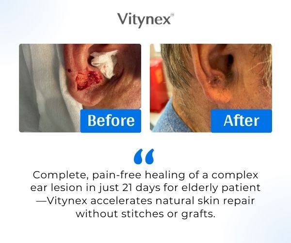Vitynex Calendula Wound Care Cream | Bed Sore & Diabetic Ulcer | 4X Fast Healing | Safe & Natural