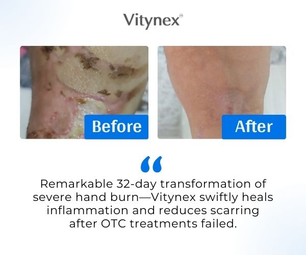 Vitynex Calendula Wound Care Cream | Bed Sore & Diabetic Ulcer | 4X Fast Healing | Safe & Natural