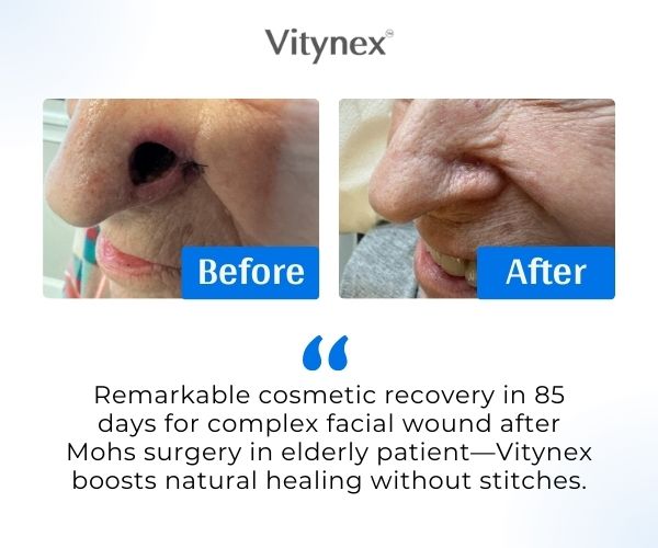 Vitynex Calendula Wound Care Cream | Bed Sore & Diabetic Ulcer | 4X Fast Healing | Safe & Natural